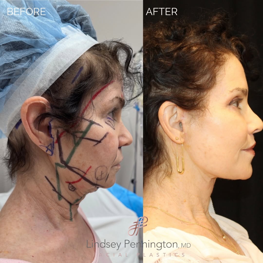 Instagram post by Dr. Lindsey Pennington: From pre op markings to just over 3 months post op ✨ The photo on the left was taken before surgery, with Dr. Pennington’s pre surgical mark…