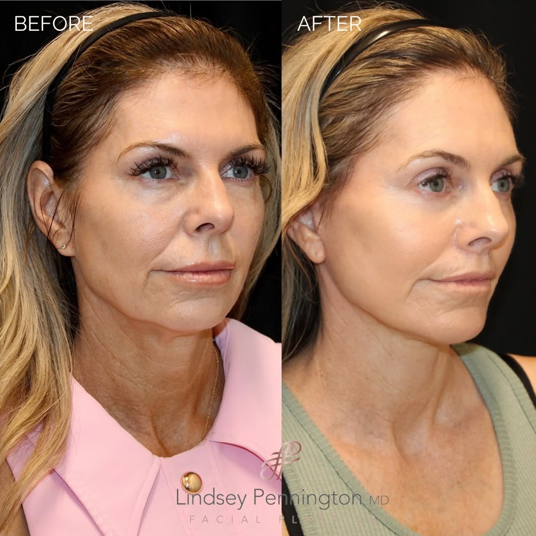 Instagram post by Dr. Lindsey Pennington: She wasn’t looking to change anything about herself. She simply wanted to feel refreshed, to look more like herself, just smoother, softer, …