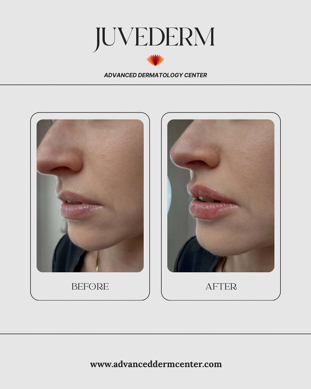 Instagram post by Dr. Lisa Benest: Because confidence is always in style.✨ Soft, elegant lip enhancement with Juvéderm—tailored to complement your natural beauty.💋 Take $50 o…