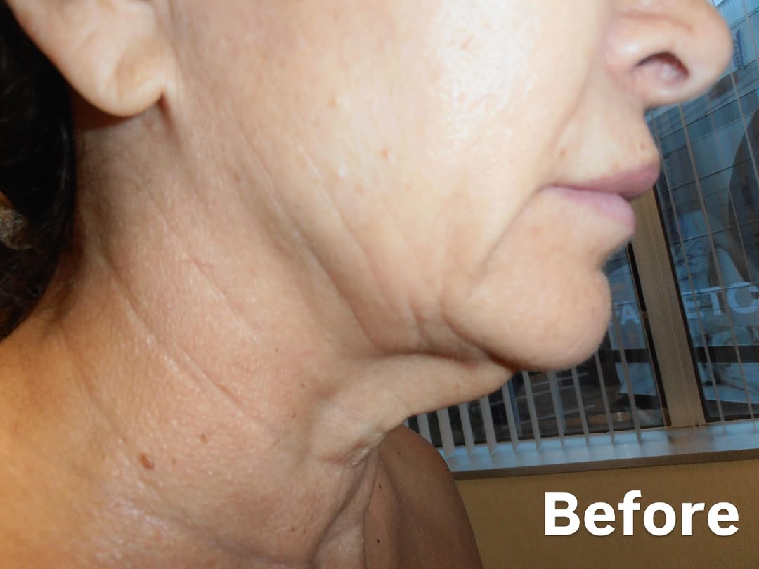 Instagram post by Dr. Lisa Hansen: Deep plane Face/Neck Lift under Local anesthesia #facelift #facelifts #necklifts #neckliftbeforeandafter #face/necklifts