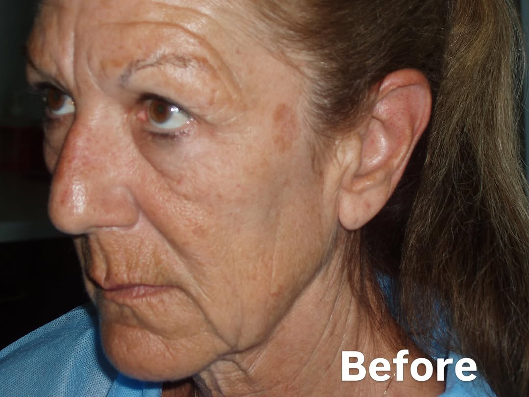 Instagram post by Dr. Lisa Hansen: Deep Plane Face/Neck Lifts under LOCAL Anesthesia with total comfort #facelifts #cosmeticsurgery #faceneckliftsurgery #facelifting #necklift