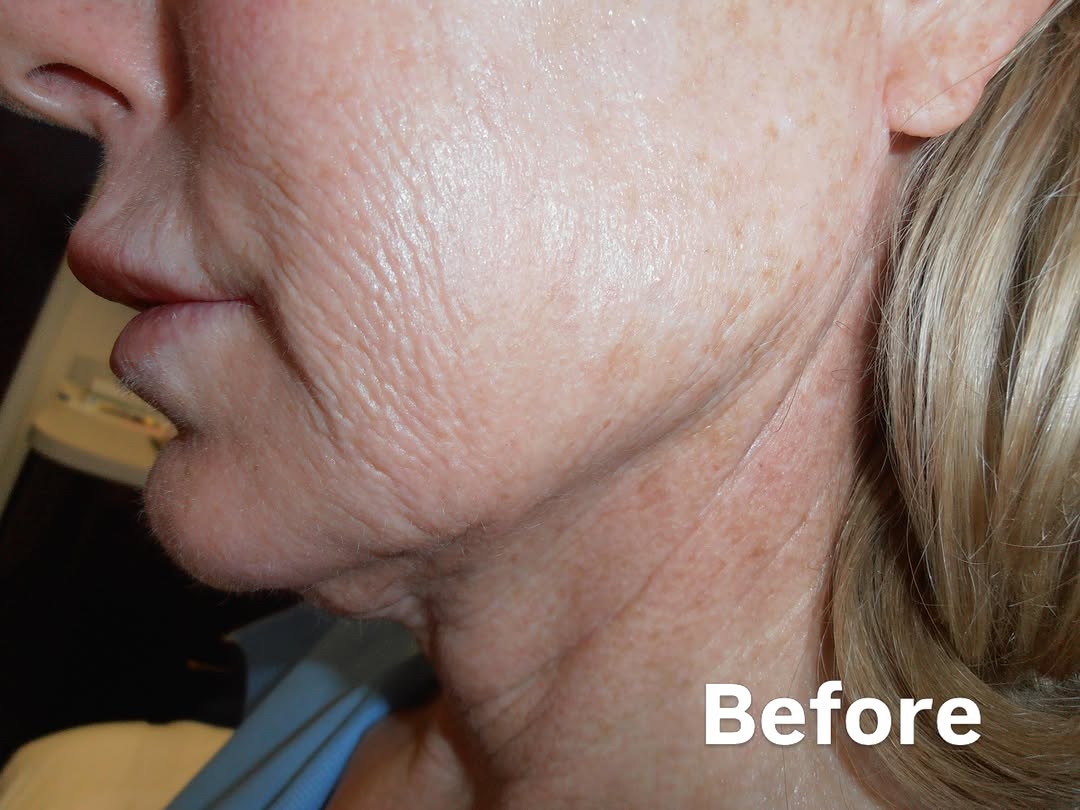 Instagram post by Dr. Lisa Hansen: Just 2 Days post Face/Neck Lift Surgery under Local Anesthesia in complete comfort! #deepplanefacelift #facelifts #cosmeticsurgery #deepplan…