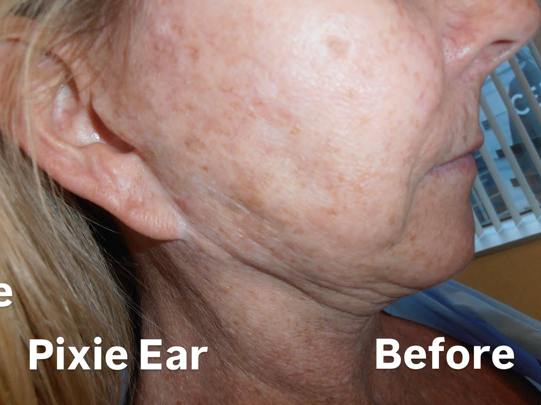 Instagram post by Dr. Lisa Hansen: Deep Plane Face/Neck Lift with Pixie Ear Repair under Local Anesthesia #deepplanefacelift #facelift #facelifts #deepplanenecklift #cosmetics…