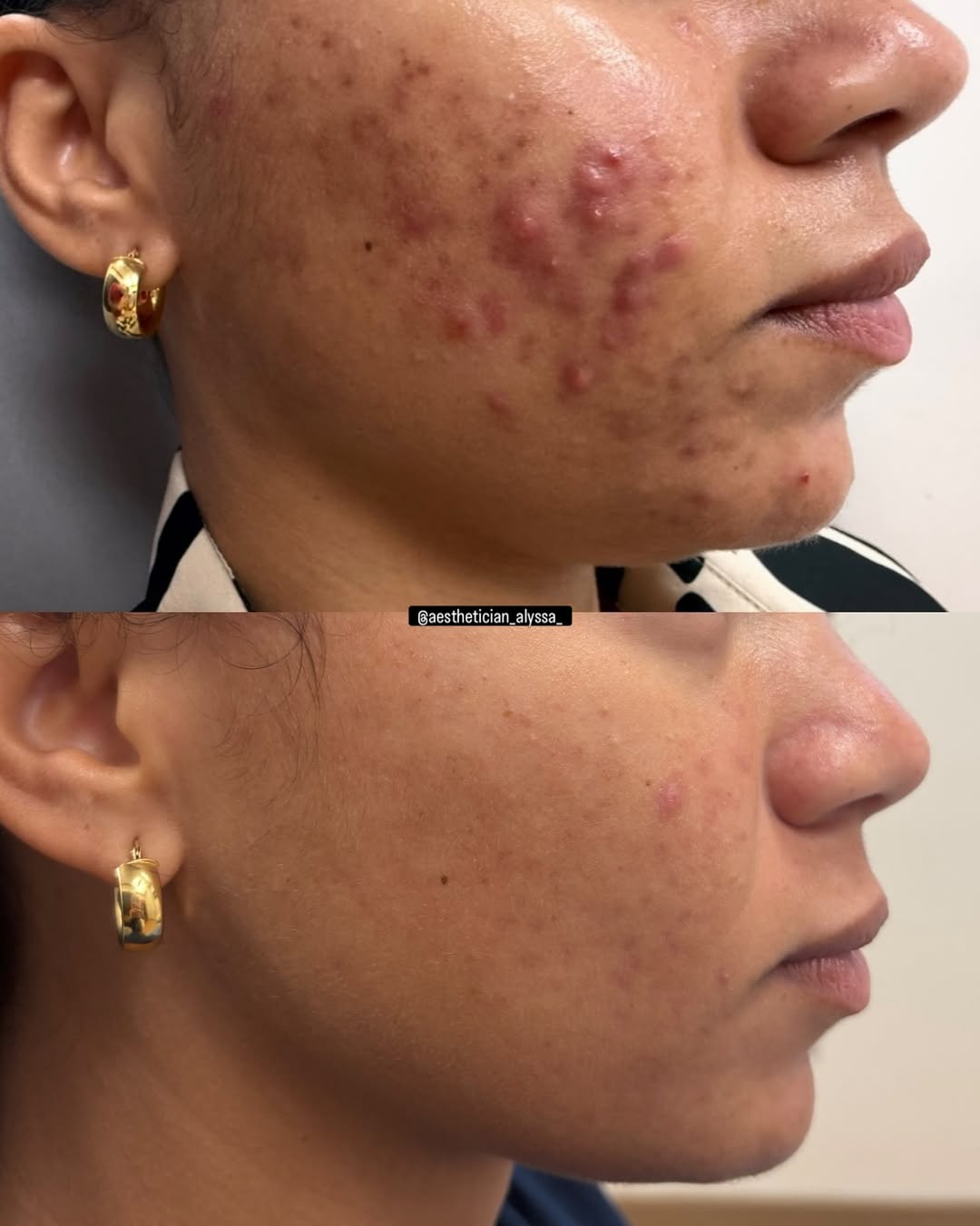 Instagram post by Dr. Lisa M. Jukes: 3 months of @zoskinhealth 💙 No treatments, no medications, no birth control, just consistent skin care 💫 Products used: Gentle cleanser Oi…