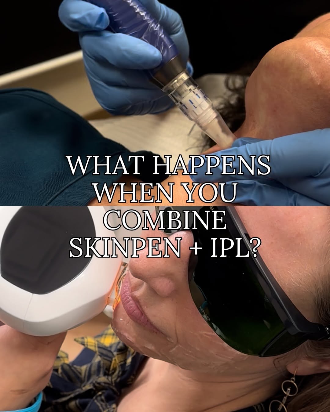 Instagram post by Dr. Lisa M. Jukes: Summer skin damage? Consider it handled. Buy SkinPen Face + Neck, get IPL Face + Neck FREE. This is an unbeatable way to reset your skin aft…
