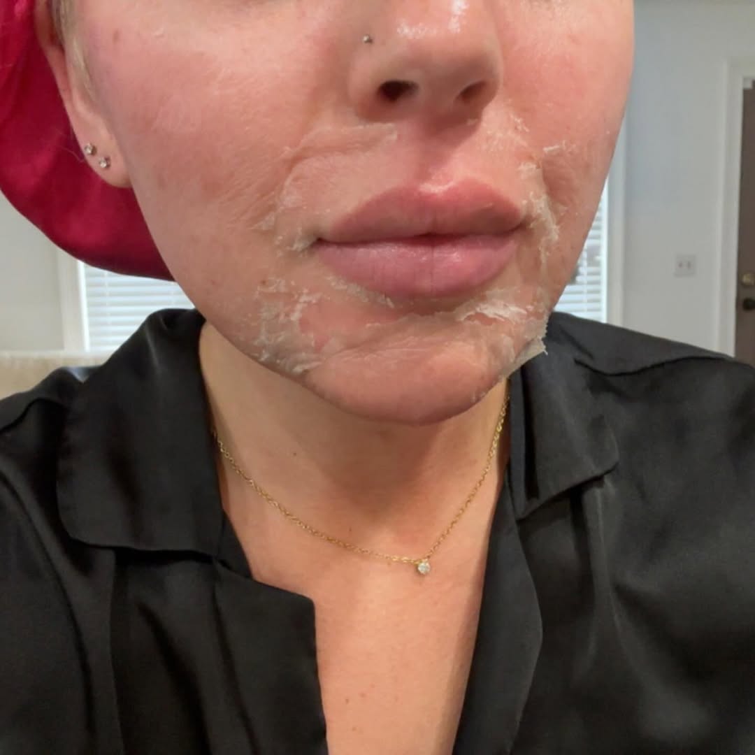 Instagram post by Dr. Lois Wagstrom: ✨ The Perfect Derma Peel = The Perfect Glow ✨ If you’ve been wanting a peel that delivers REAL, visible results… this is the one. The Perfec…