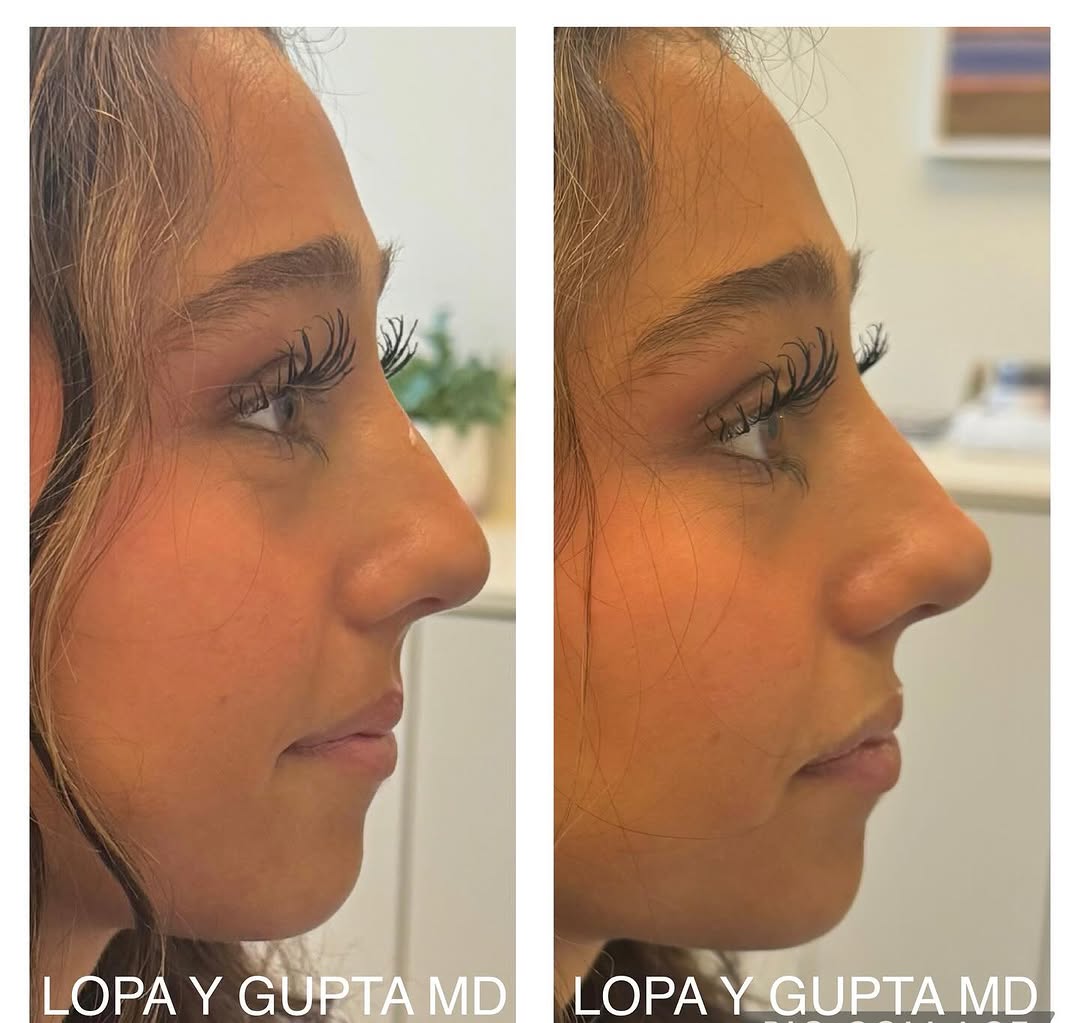 Instagram post by Dr. Lopa Gupta: Just a few drops of artistry....look how a liquid rhinoplasty can transform not only her nose but her entire profile and self esteem. No sur…