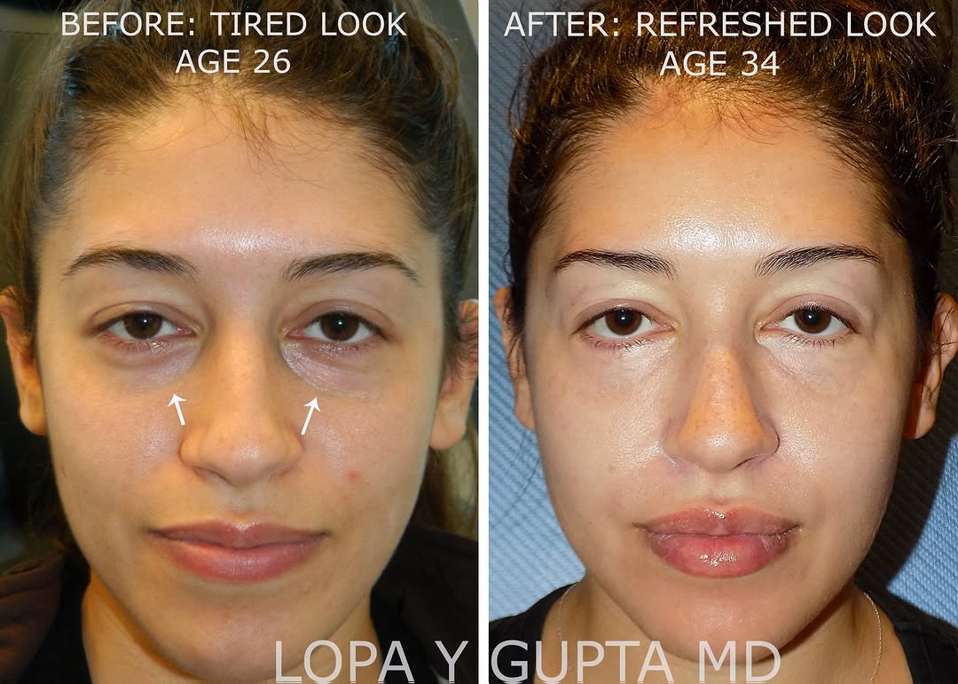 Instagram post by Dr. Lopa Gupta: This lovely patient underwent laser lower blepharoplasty 8 years ago, at the age of 26. This improved her undereye bags. Dissolvable threads…