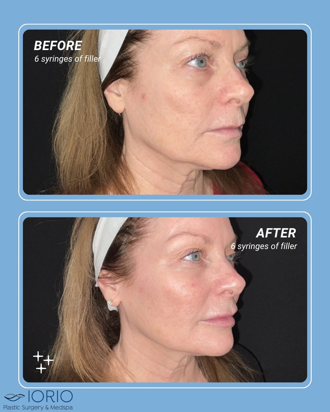 Instagram post by Dr. Louis M. Iorio: ✨ Facial Contouring with 6 syringes of filler & full face neuromodulators ✨ One of my favorite treatments to perform is facial contouring be…
