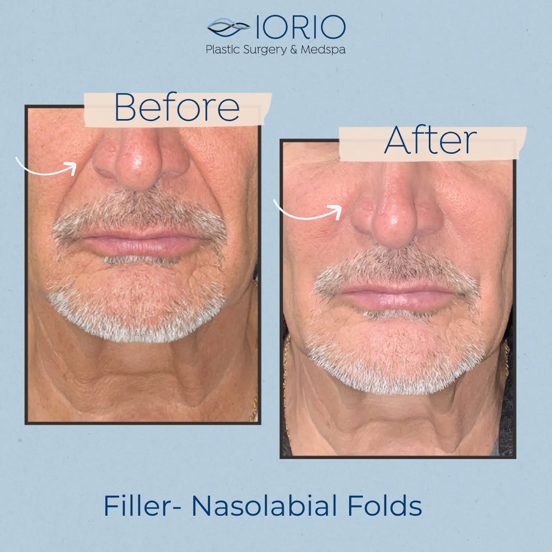 Instagram post by Dr. Louis M. Iorio: Ever wonder what filler can do for smile lines? Nasolabial fold filler helps restore volume beneath the skin, softening deep folds that natu…