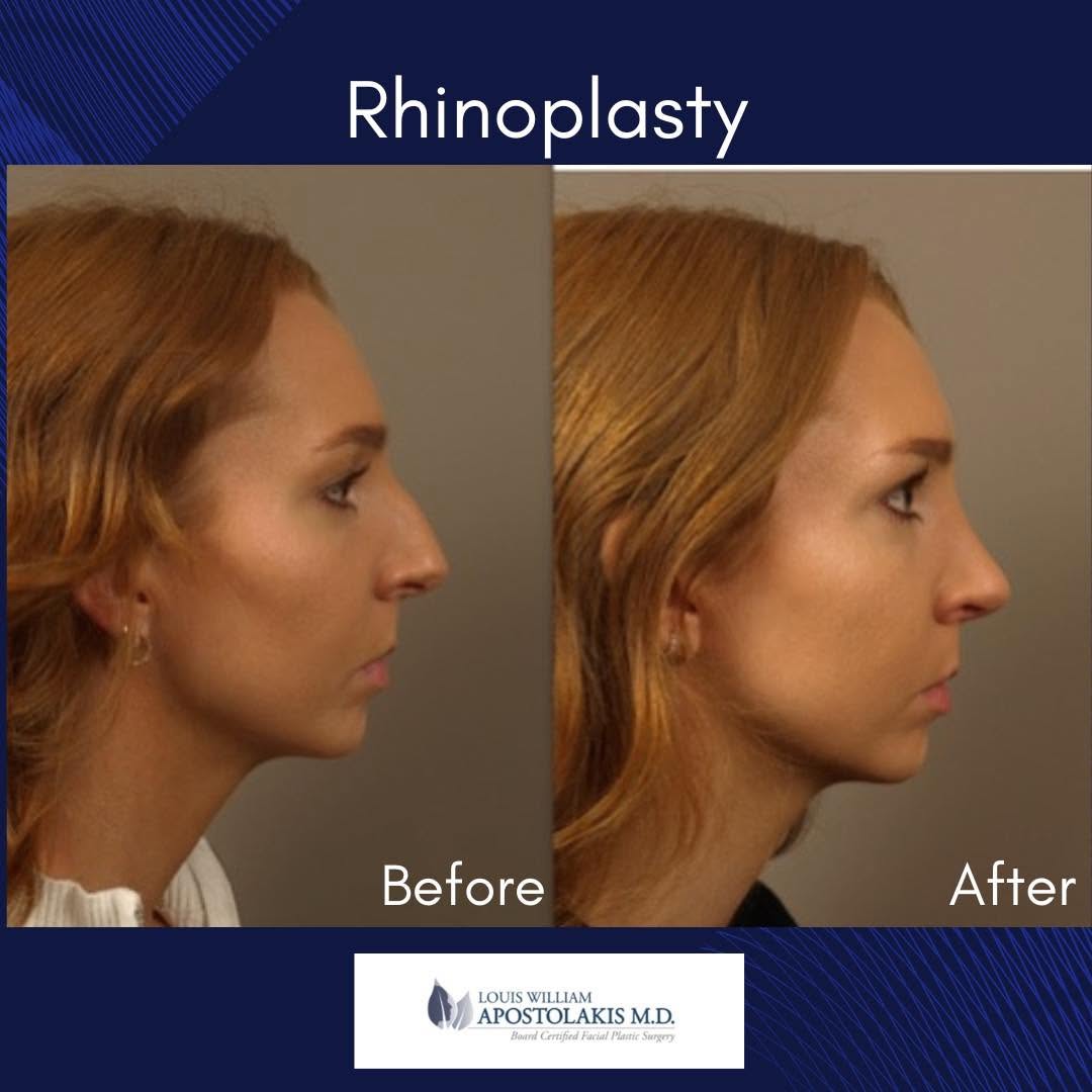 Instagram post by Dr. Louis W. Apostolakis: A refined approach to balance and harmony - lifting the tip, smoothing the profile, and softening visible contours for a natural, elegant re…
