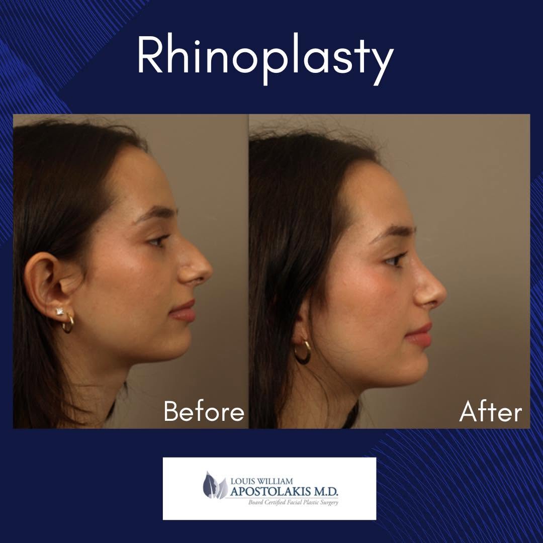 Instagram post by Dr. Louis W. Apostolakis: This patient desired a more refined nasal profile while preserving her natural beauty. Rhinoplasty was performed to reduce the dorsal hump, …