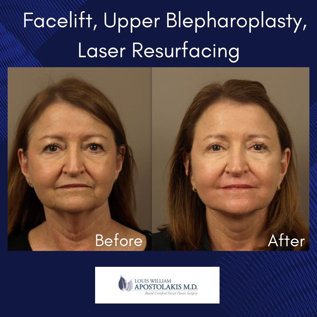 Instagram post by Dr. Louis W. Apostolakis: This patient sought facial rejuvenation that would restore a more youthful appearance while preserving the qualities that make her uniquely …
