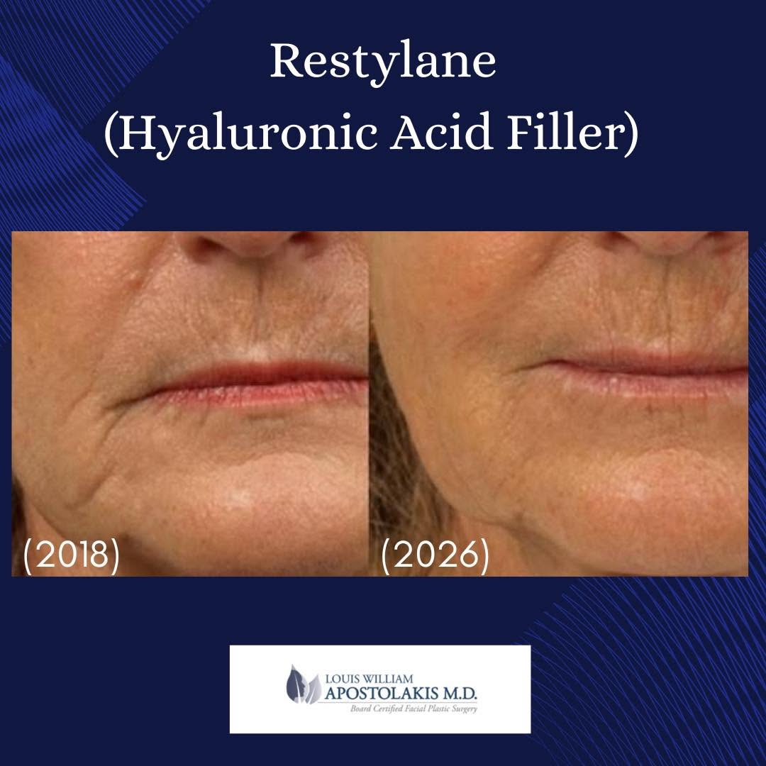 Instagram post by Dr. Louis W. Apostolakis: Subtle, long-lasting change; we call this micro-Restylane. Small amounts of hyaluronic acid filler (Restylane) placed strategically over tim…
