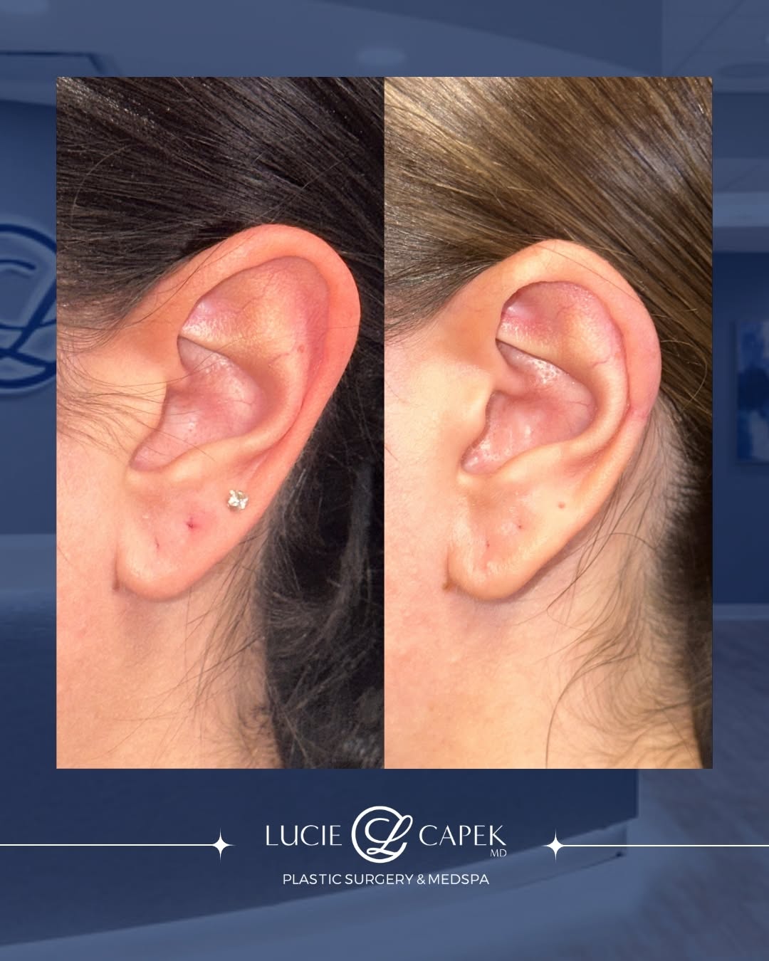 Instagram post by Dr. Lucie Capek: One of the things I love about ear surgery is how much can be accomplished with thoughtful, precise changes 👂📐 For this patient, I perform…