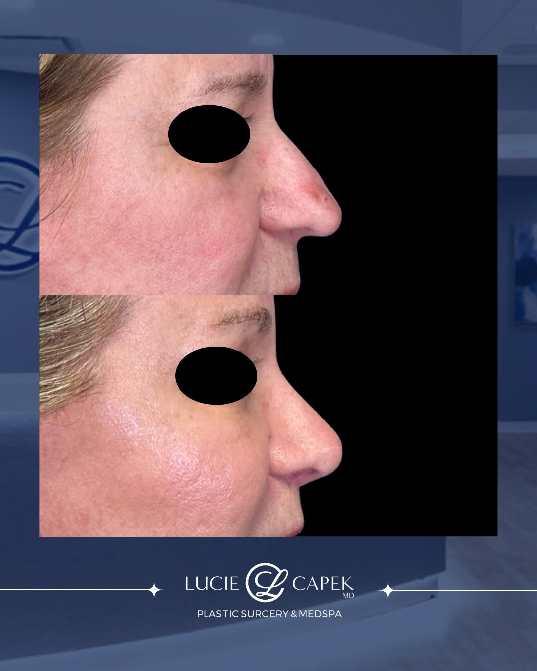 Instagram post by Dr. Lucie Capek: This lovely patient had spent much of her life feeling unhappy with the appearance of her nose. 👃 When she came to see me, she asked for a …