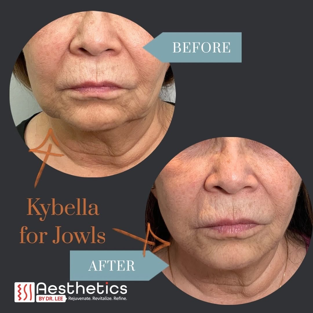 Instagram post by Dr. Luis Lee: Let’s talk JOWLS- Above showcases a before and after photo of a patient after two sessions of Kybella. Experience the rare and cutting-edge …