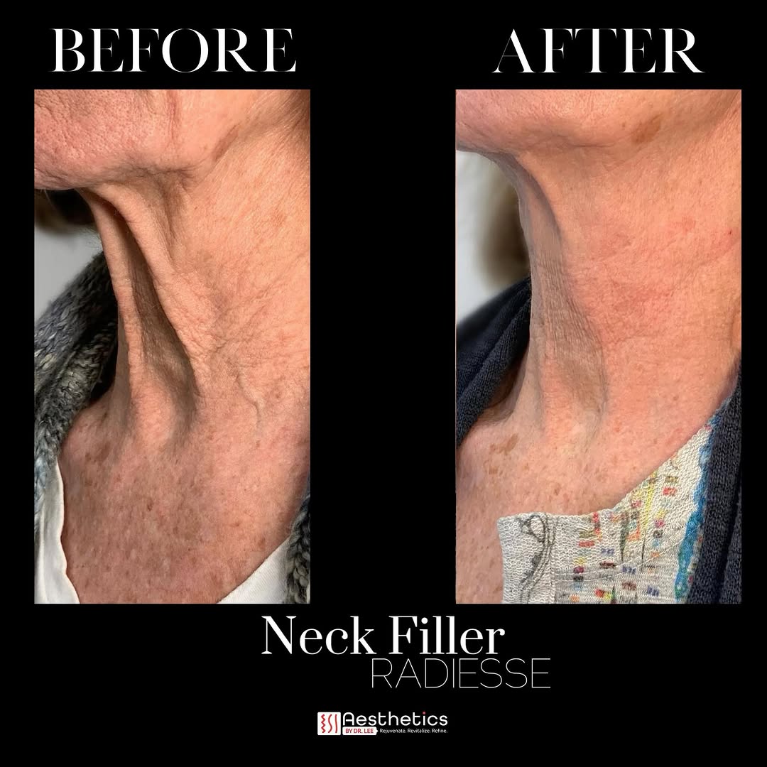 Instagram post by Dr. Luis Lee: Thanksgiving is the only turkey neck that’s allowed! We can take care of this one for you 💉😏. This is after two sessions of @radiesse!! Wo…