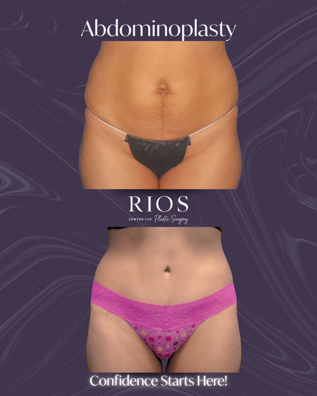 Instagram post by Dr. Luis M. Rios Jr.: Abdominoplasty results — 5 YEARS later. ✨ 📊 Age 31 | Height 5'5" | Weight 134 lbs This is what long-term results look like when a tummy tuc…
