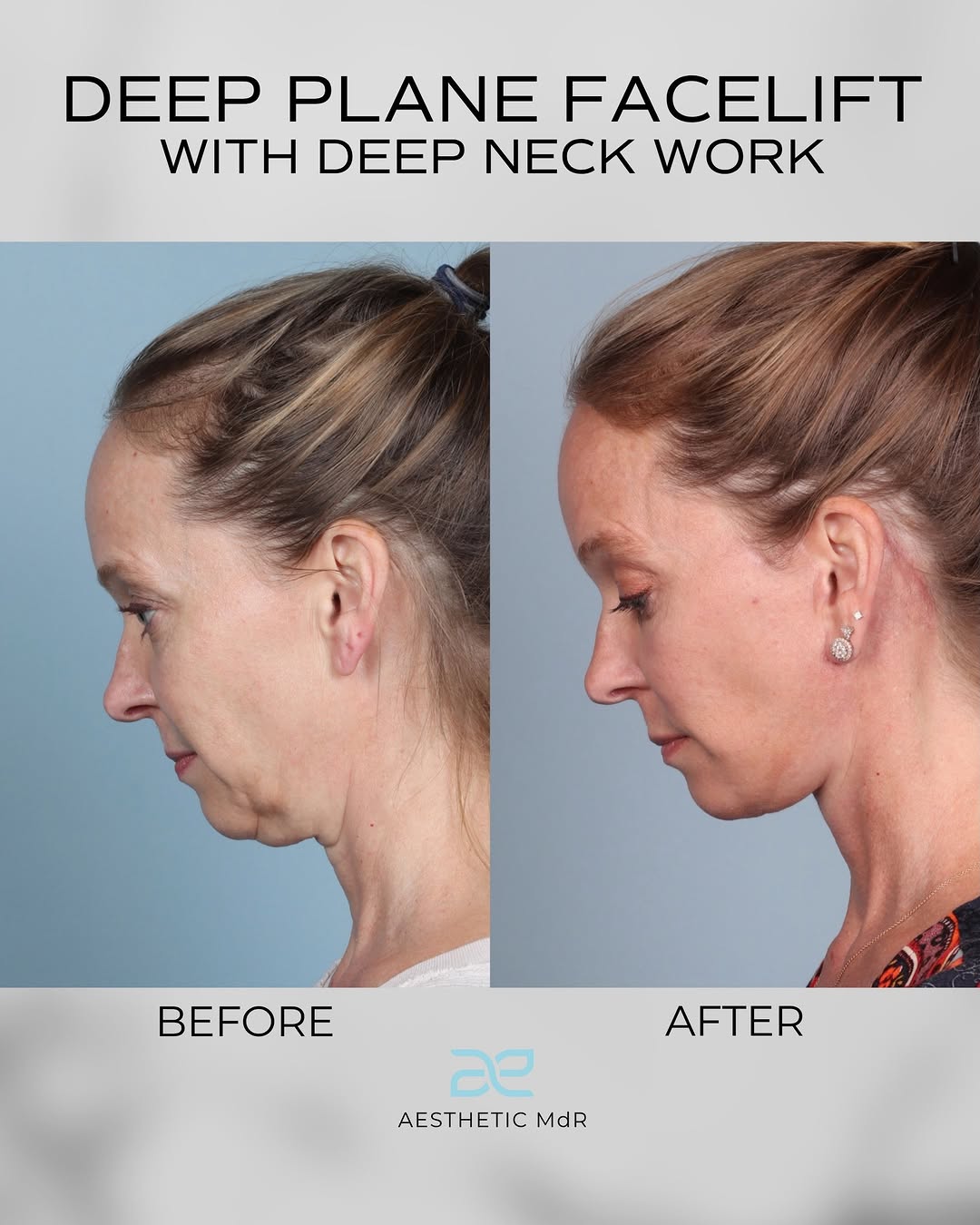 Instagram post by Dr. Luis Macias: Six months post-op and a great example of comprehensive facial rejuvenation. This patient underwent a Deep Plane Facelift with deep neck wor…