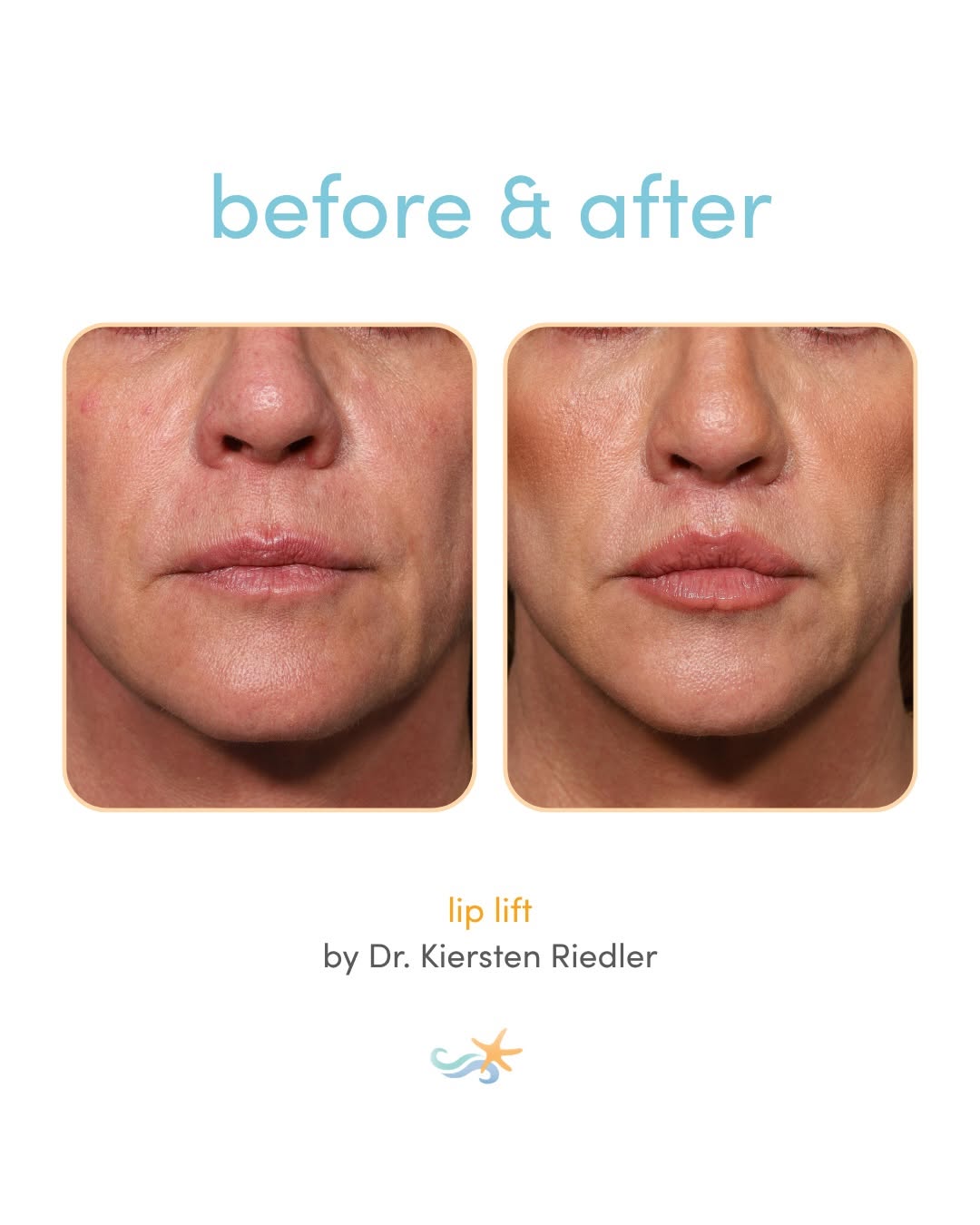 Instagram post by Dr. Luke Swistun: ✨ Fuller, more youthful lips — five months post lip lift with Dr. Riedler ✨ She’s loving her new smile, and we’re loving her results! Book y…
