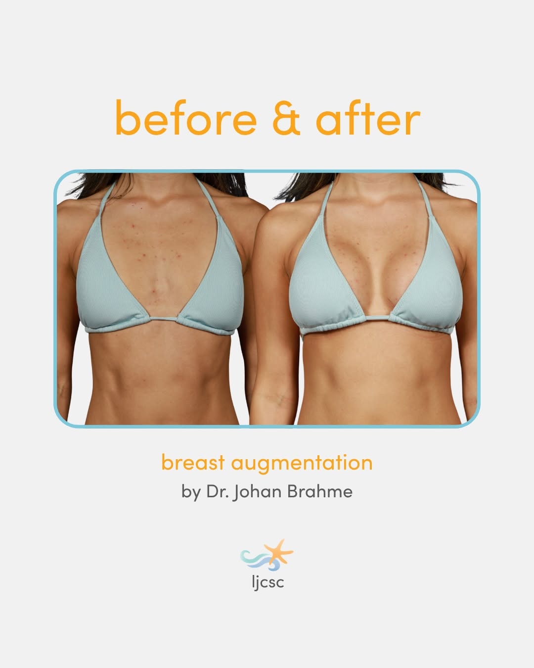 Instagram post by Dr. Luke Swistun: Volume restored. Confidence renewed. ✨ Dr. Brahme combined a breast augmentation + lift to bring back the shape she’d been missing. 🙌 📲 Bo…