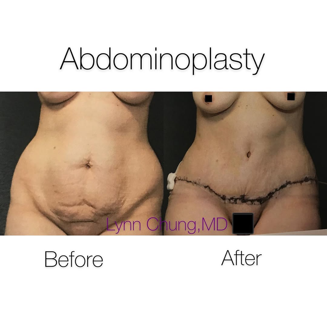 Instagram post by Dr. Lynn Chung: Beautiful results one week after a tummy tuck. This hardworking mom of 2 finally was able to take some time to get her pre-baby body back! S…