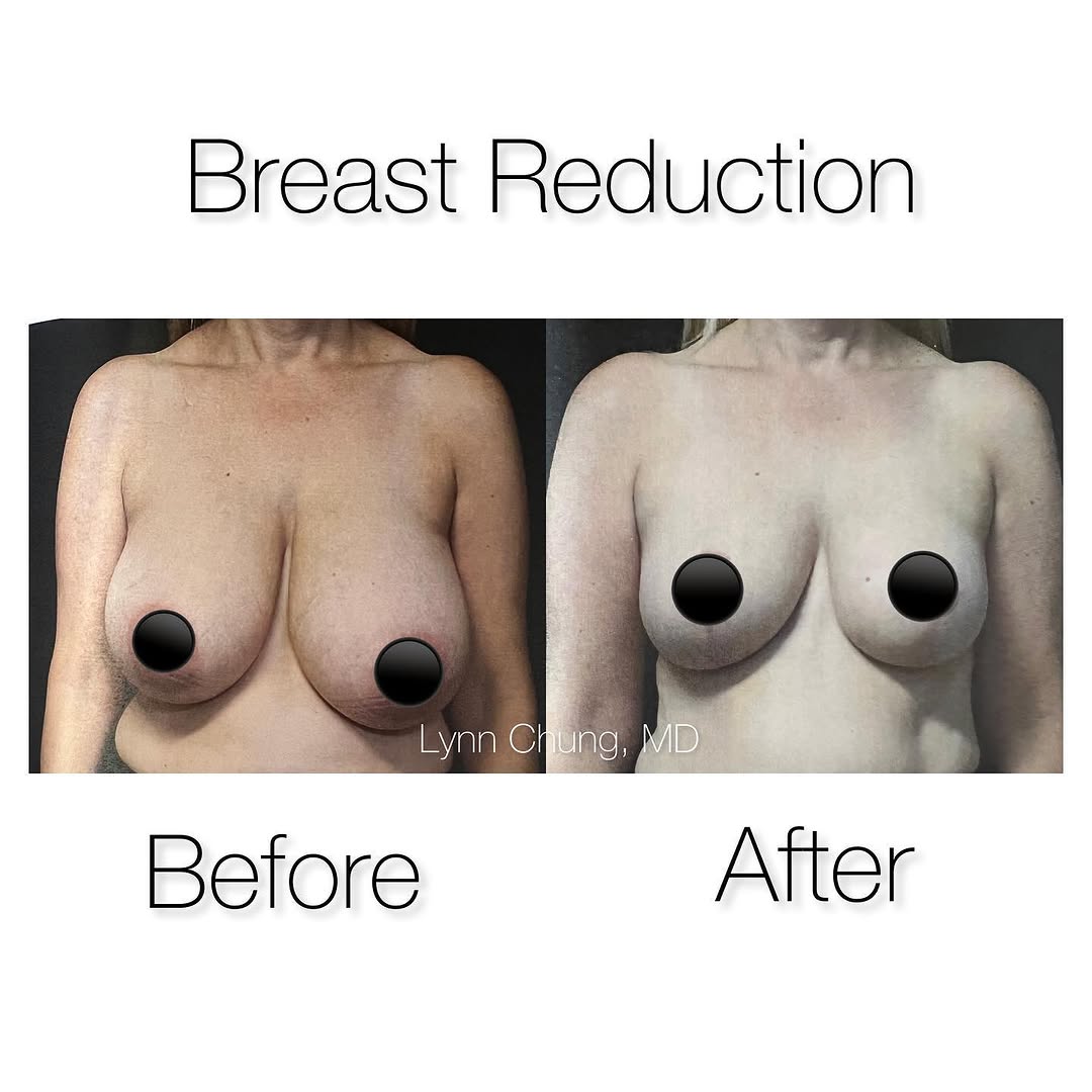Instagram post by Dr. Lynn Chung: Before and after breast reduction for this lovely patient. She had large breasts which made it difficult for her to find clothing that fit o…