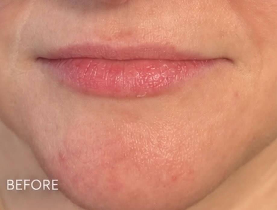 Instagram post by Dr. Lynn Chung: Small details make the biggest difference 💕 ✔️ Hydration ✔️ Shape refinement ✔️ Natural volume #cleanbeauty #nurseinjector #selfcareaesthet…