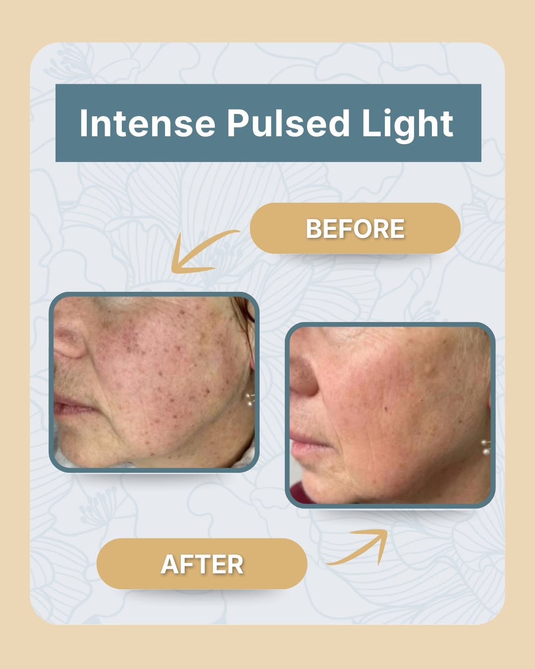 Instagram post by Dr. Lynn Flowers: 👀 Seeing is believing, so we are letting the results do the talking. ⠀ ⠀ We are sharing real before-and-afters from the Stellar M22 this we…