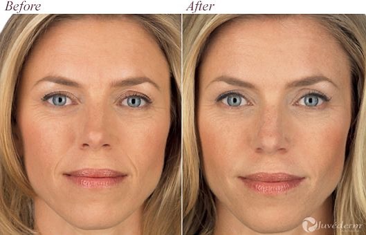 Instagram post by Dr. M. David Cole: ✨Do you want to reduce the appearance of #fine lines and #wrinkles? Dermal fillers may be the answer! ✨ Dr. Cole can revamp your look with s…