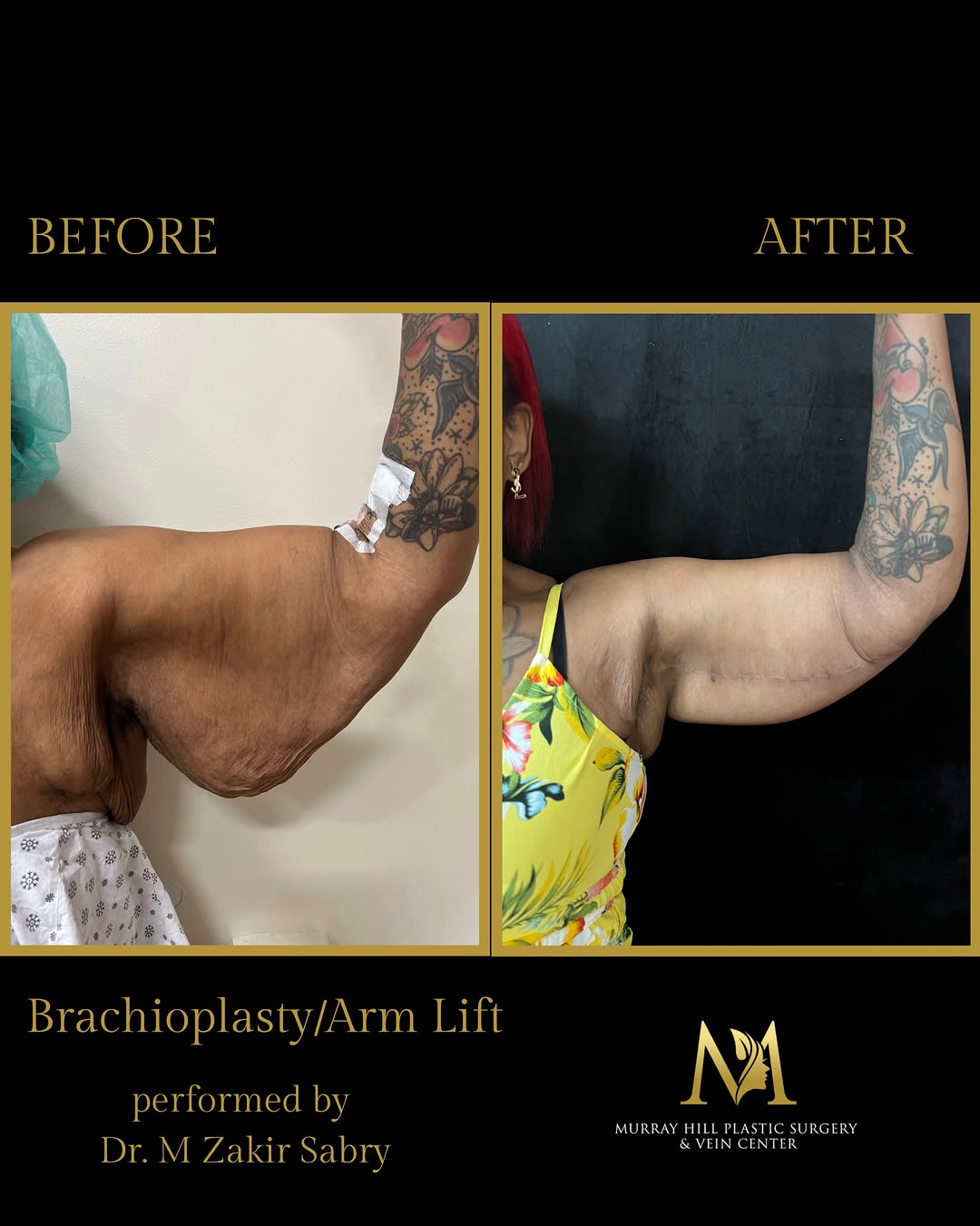 Instagram post by Dr. M. Zakir Sabry: Before and after results 3 months post-op from a brachioplasty, also known as an arm lift, performed by Dr. M. Zakir Sabry at Murray Hill Pl…