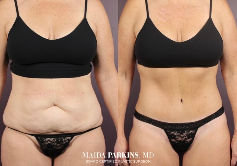 Instagram post by Dr. Maida Parkins: This stunning transformation showcases the results of an extended lipoabdominoplasty, designed to sculpt the abdomen, remove excess skin and…