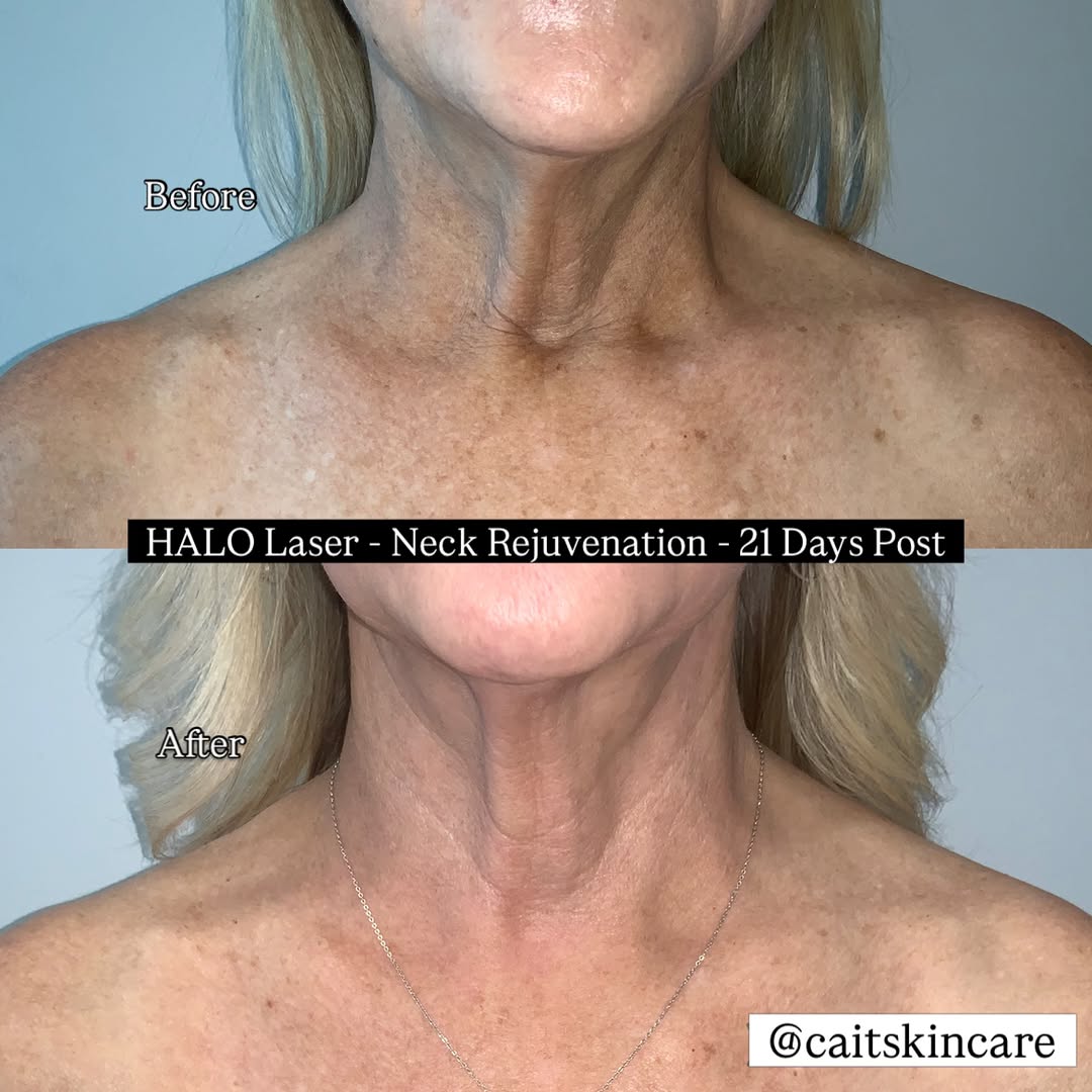 Instagram post by Dr. Maida Parkins: HALO Laser | Neck Rejuvenation ✨ 21 days post-laser and this neck is already showing a beautiful transformation. HALO Laser can help address…