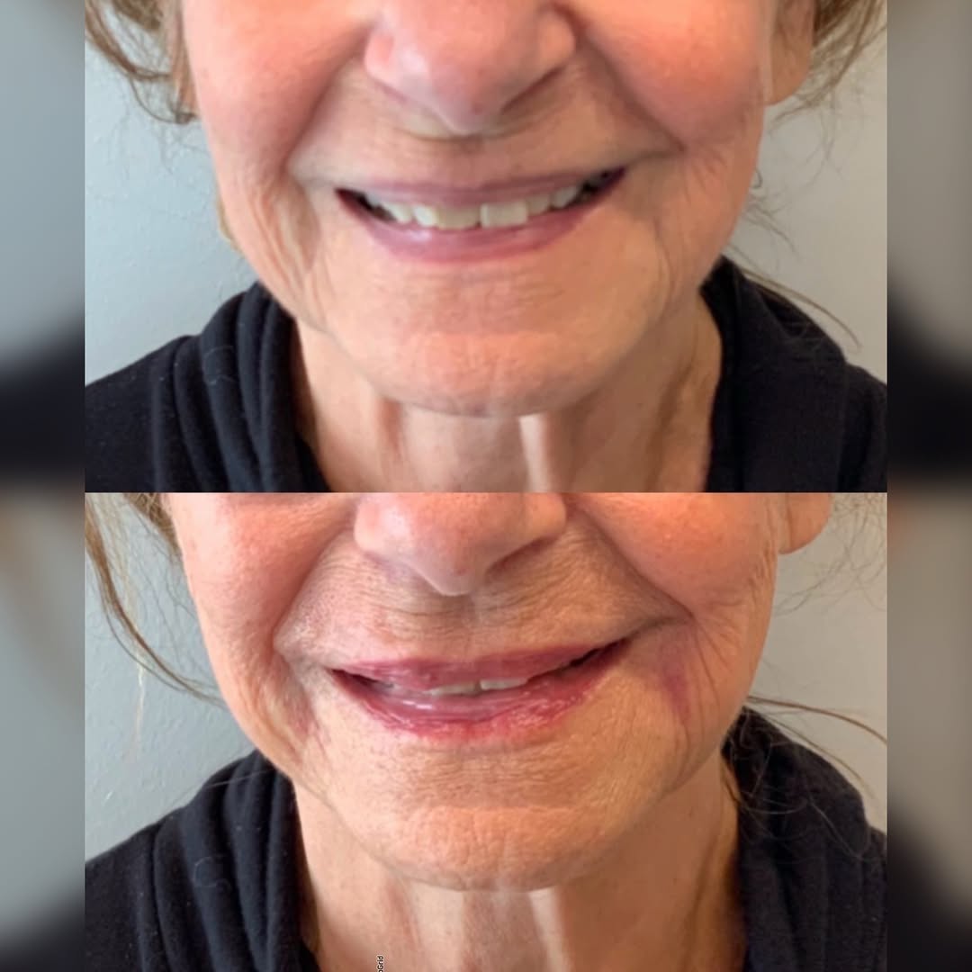 Instagram post by Dr. Maida Parkins: 👄Lip Restoration ➡️ One of my favorite & most impactful ways to help undo the aging process! 👌🏼 🪄🕰️ Rolling back the hands of time #ant…