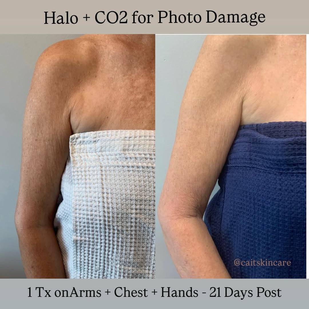 Instagram post by Dr. Maida Parkins: ✨ 21 DAYS AFTER HALO + CO₂ ✨ Photo damage doesn’t happen overnight—and treating it effectively takes more than one approach. This HALO + CO₂…