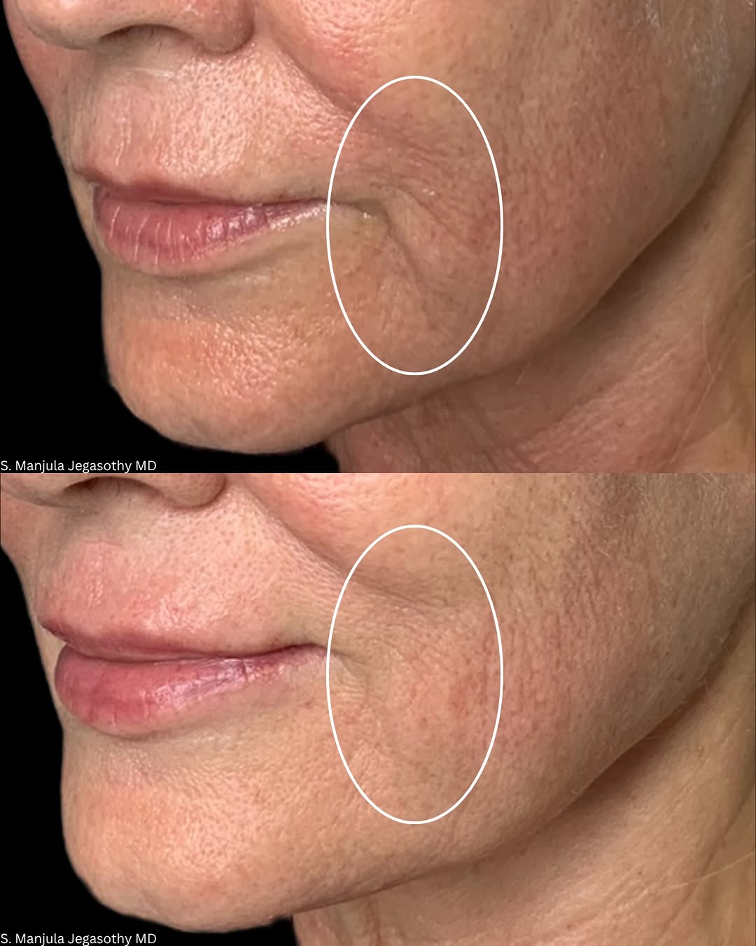 Instagram post by Dr. Manjula Jegasothy: Ulthera + filler: a stacked approach to making a sad mouth happy again. ✨ A downturned mouth can make the lower face look tired, heavy, or s…