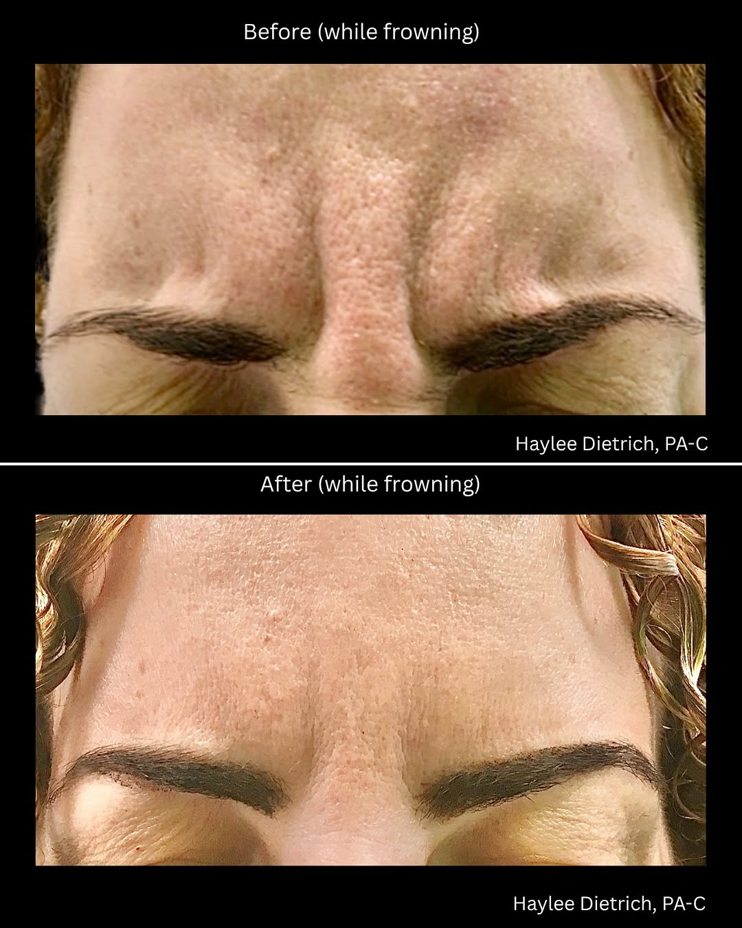 Instagram post by Dr. Manjula Jegasothy: Ulthera + BOTOX: a stacked approach to keeping the frown but losing the “11s.” ✨ A frown can make the upper face look tense, serious, or tir…