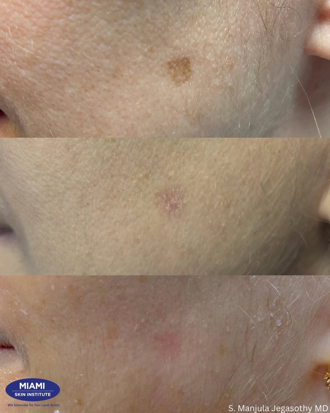 Instagram post by Dr. Manjula Jegasothy: A small dark spot can make a noticeable difference in how the skin looks up close, in direct light, and under makeup. ✨ This before-and-afte…