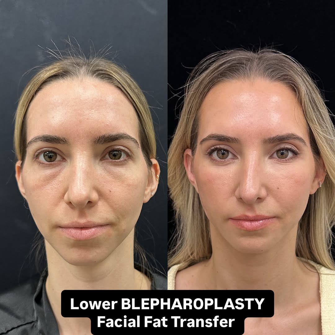 Instagram post by Dr. Mansher Singh: A subtle change can make such a beautiful difference ✨ This patient underwent lower blepharoplasty + facial fat transfer to soften the under…