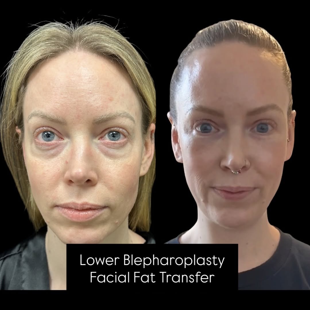 Instagram post by Dr. Mansher Singh: Less tired. More refreshed. Lower blepharoplasty combined with facial fat transfer to restore youthful volume—without looking overdone. #Low…