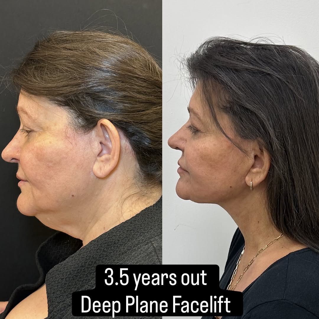 Instagram post by Dr. Mansher Singh: 3.5 years later, and the results are still holding beautifully. One of my favorite things about a deep plane facelift is seeing how naturall…