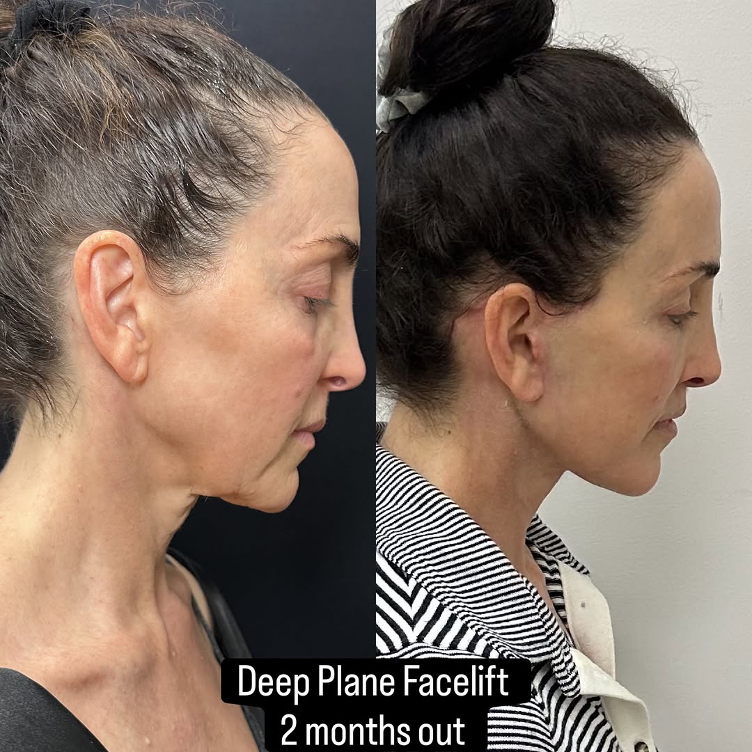 Instagram post by Dr. Mansher Singh: Trust the process! #deepplanefacelift