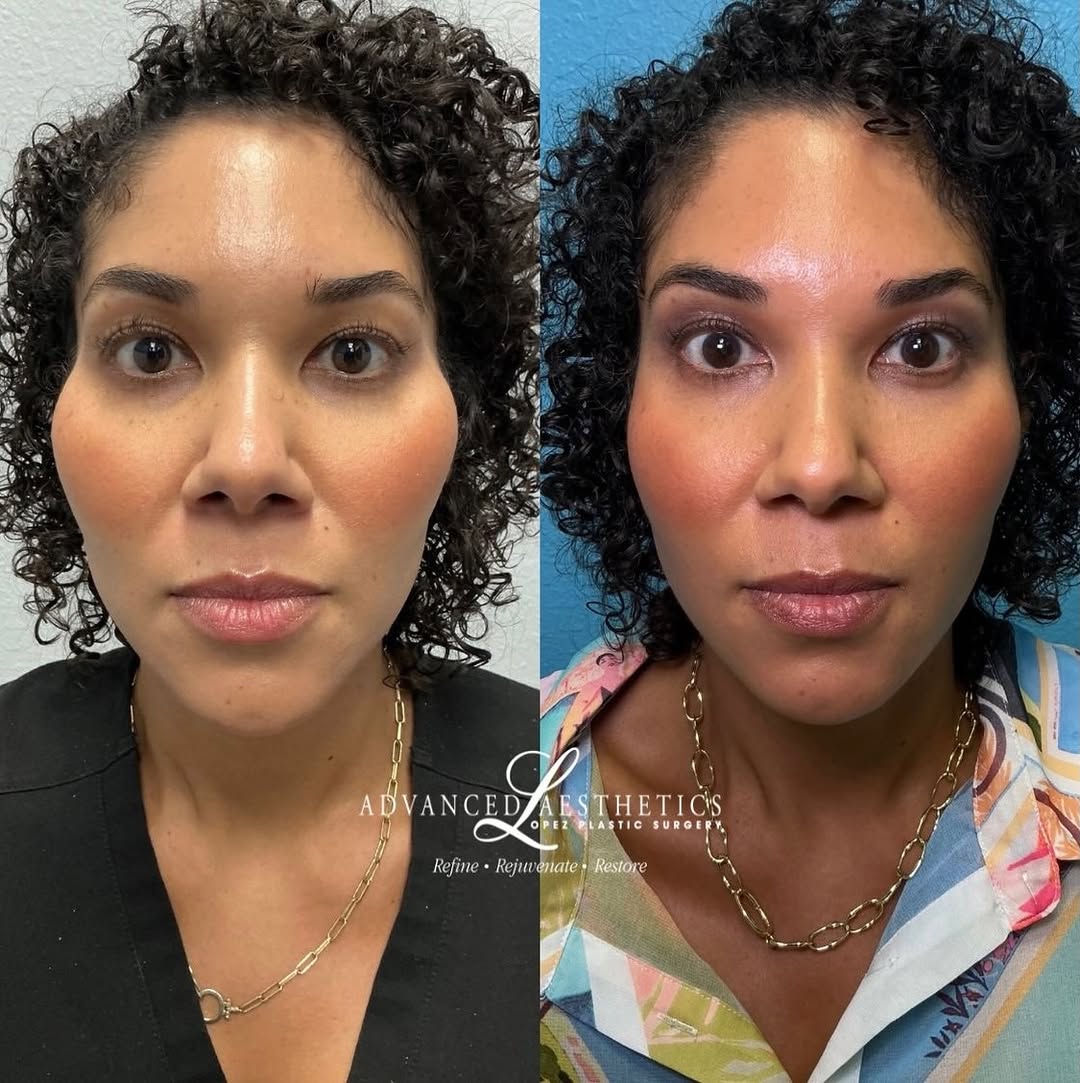 Instagram post by Dr. Manuel A. Lopez: Sometimes, the best filler treatment is actually dissolving first. Over time, volume through the lateral cheeks had created a stronger cheek…