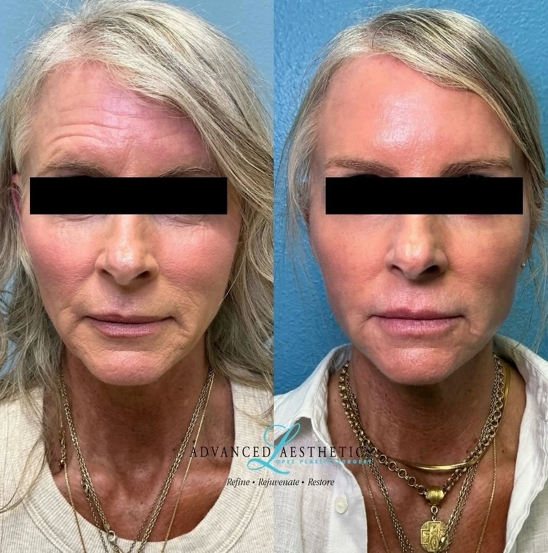 Instagram post by Dr. Manuel A. Lopez: This is what comprehensive rejuvenation looks like. 🫶 Not changing her features. Not chasing one line at a time. Just thoughtfully treating…