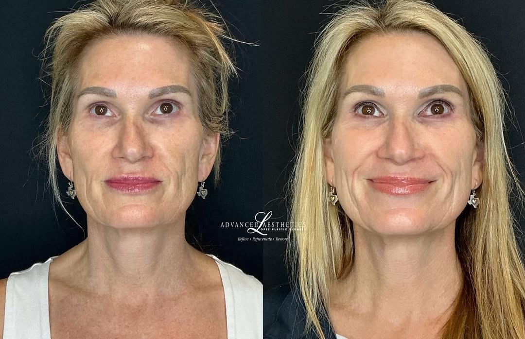 Instagram post by Dr. Manuel A. Lopez: ✨ Brighter, smoother, more even-looking skin from face to neck ✨ This before & after showcases the results of a customized HALO + Forever Yo…