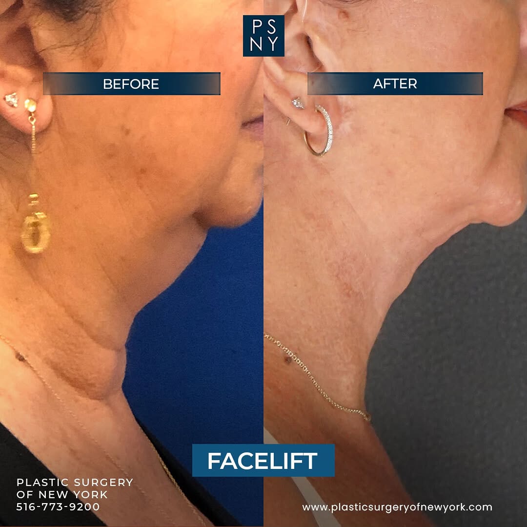 Instagram post by Dr. Marc Elkowitz: We are thrilled to share the incredible transformation of one of our remarkable patients! She underwent a facelift surgery that completely c…
