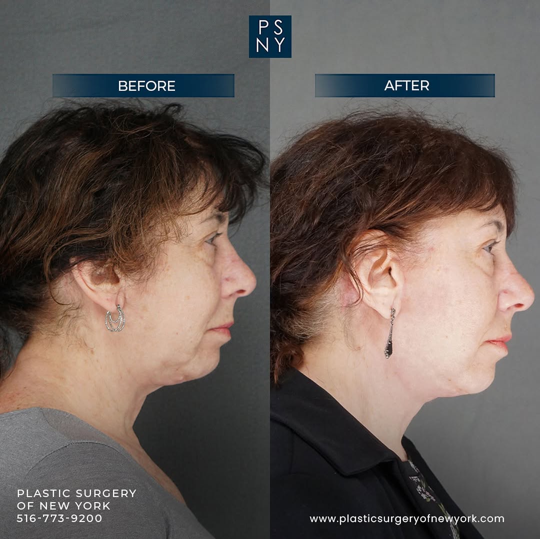 Instagram post by Dr. Marc Elkowitz: How long does a facelift last? Facelift results can last for at least 10 years or more. A facelift helps you turn back the clock. You can ma…