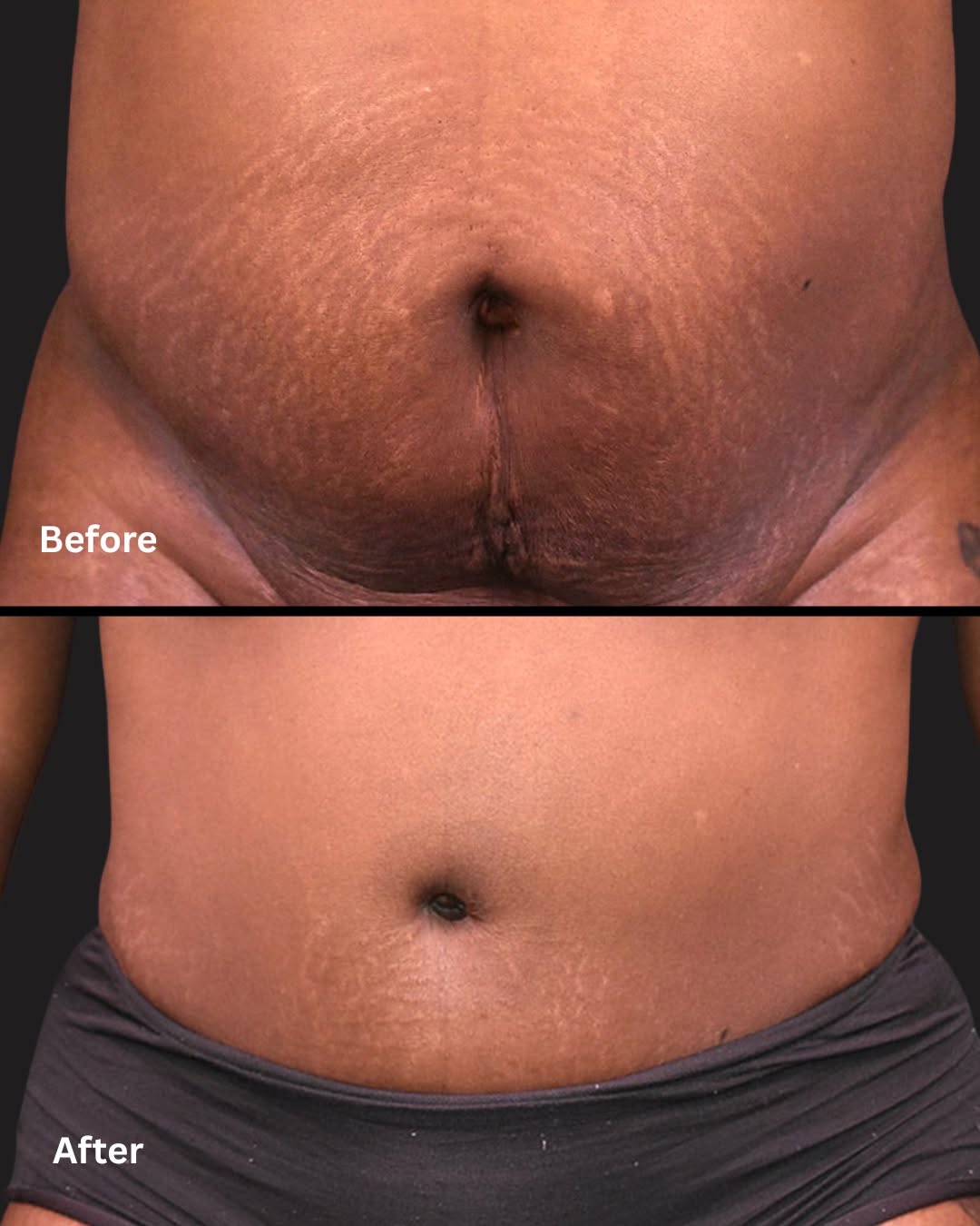 Instagram post by Dr. Marc Klein: She took the first step and look at her now. Book your consultation today to see if a tummy tuck is the solution you've been looking for. #a…