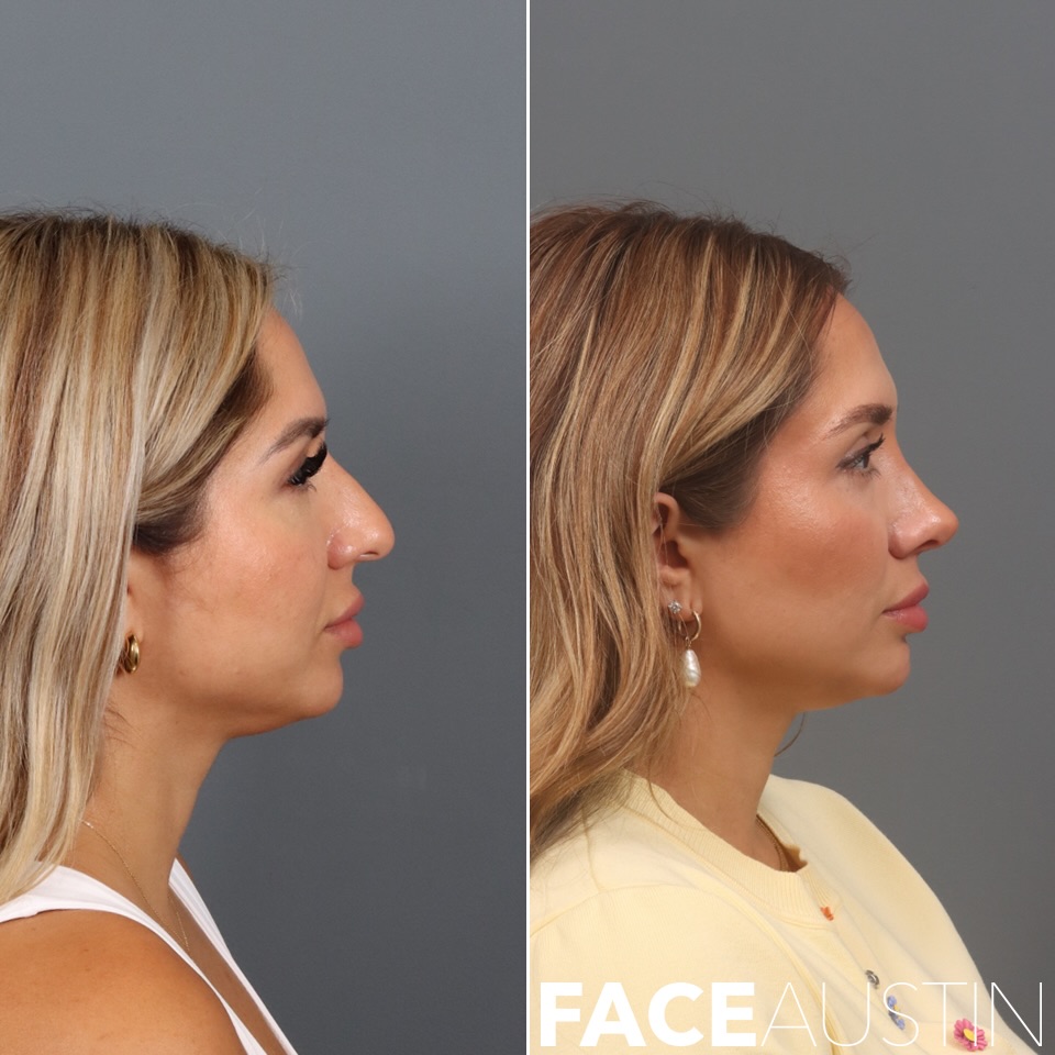 Instagram post by Dr. Marcelo Antunes: One year after rhinoplasty. Rhinoplasty is about more than changing the profile. Every adjustment has to work from the front, profile, and t…